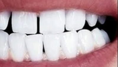 Remove Tartar and Whiten Your Teeth Naturally with Sage Leaves