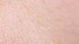 My sister developed this painful bubbling blister on her lip right before her wedding. She is freaking out and needs it gone immediately. Any tips?