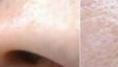 APPLE VINEGAR Removes WARTS in 24 HOURS! Just Do This…