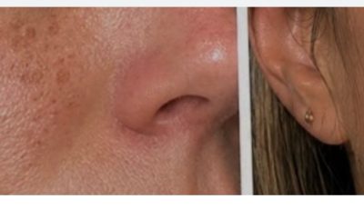 How to use baking soda to remove dark spots, wrinkles and dark circles from your