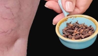 Relieve Leg Pain, Rheumatism, Varicose Veins, and Arthritis with Garlic and Cloves